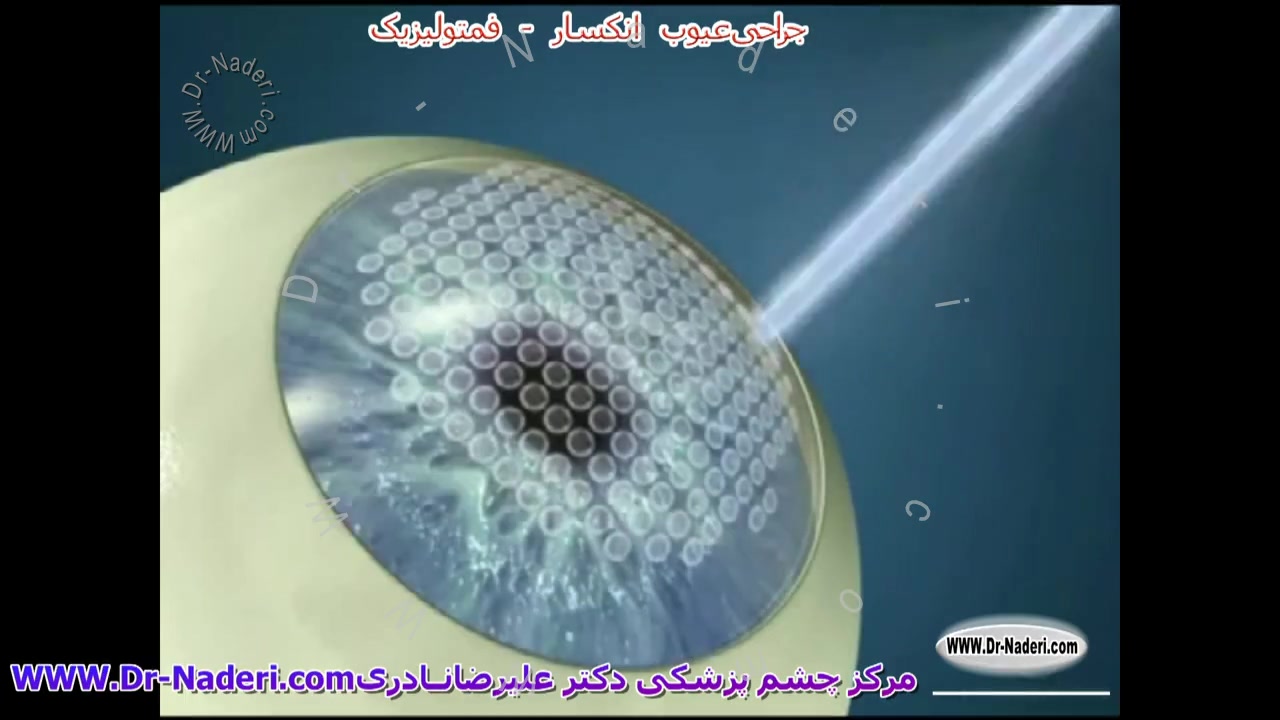 جراحی فمتولیزیک - مرکز چشم پزشکی دکتر علیرضا نادری