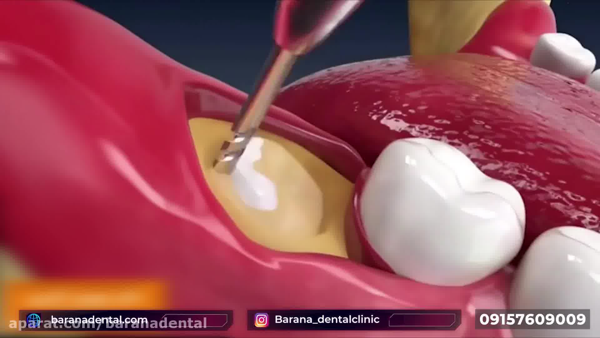انیمیشن جراحی دندان عقل