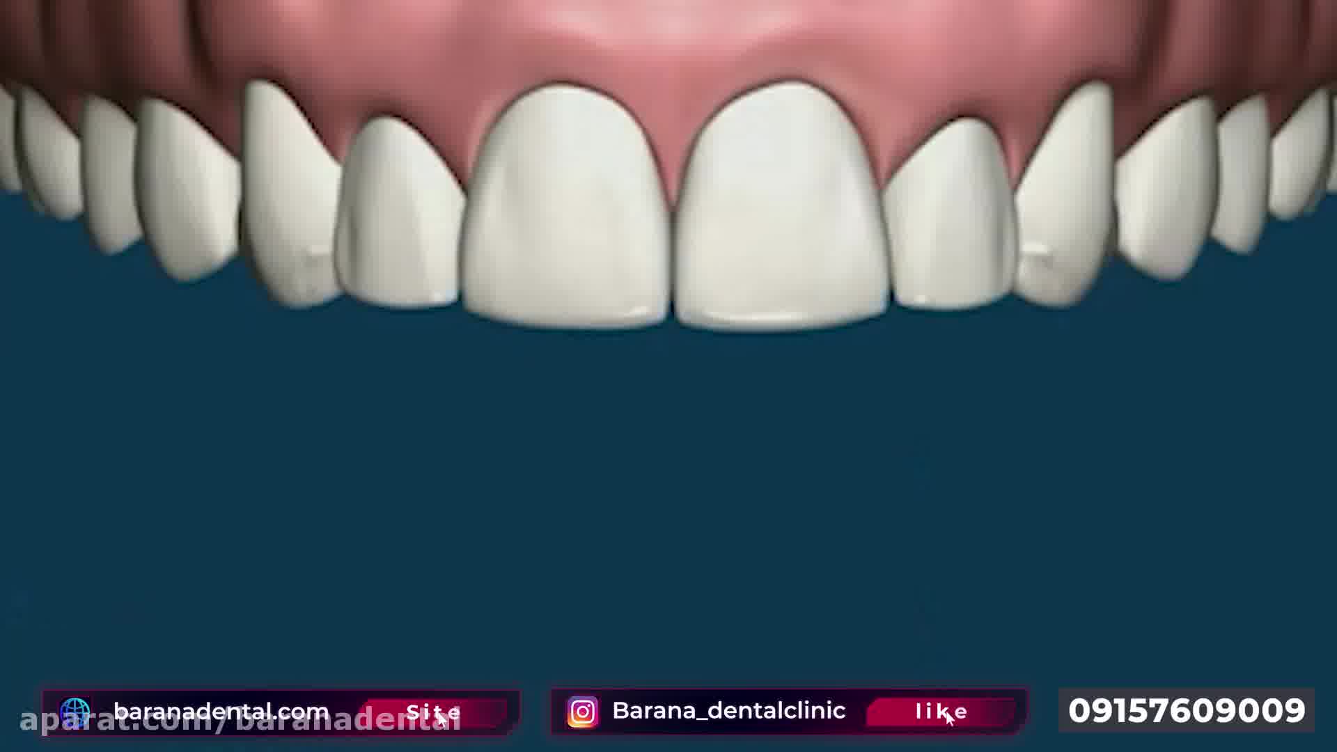بستن فاصله بین دندانی با انجام کامپوزیت دندان