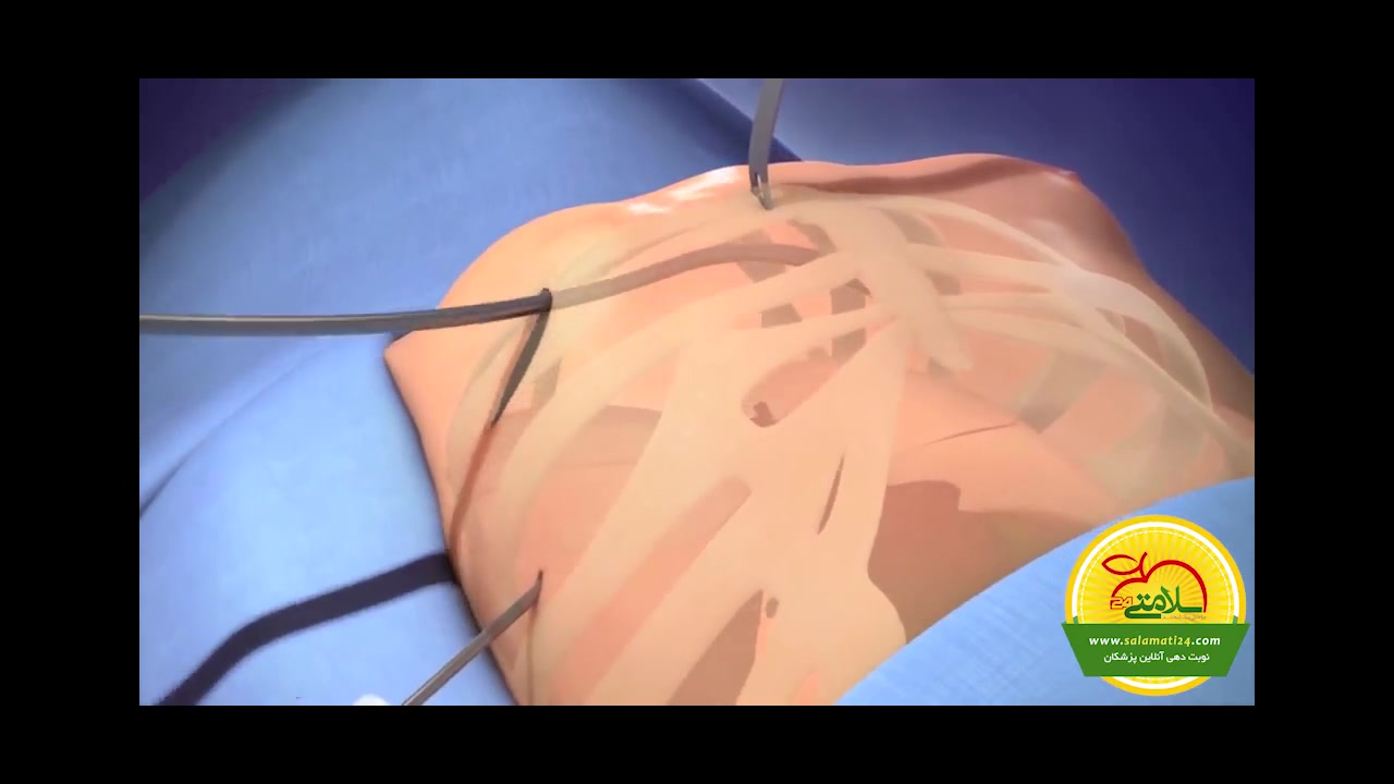 جراحی قفسه سینه قیفی شکل یا فرورفتگی قفسه سینه