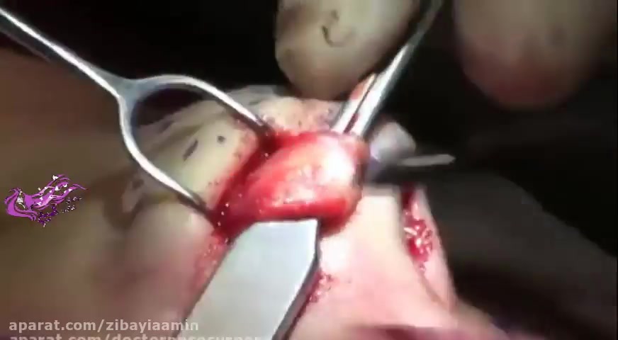 جراحی بینی