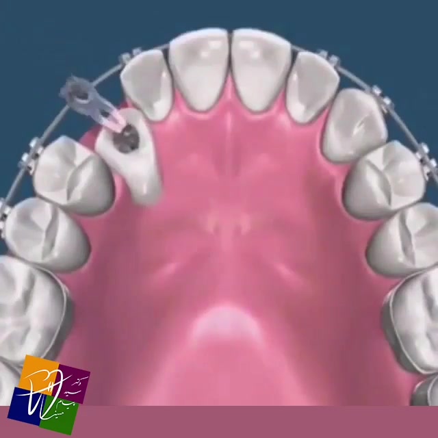 حرکت دندان نیش نهفته داخل فک به سمت قوس دندانی