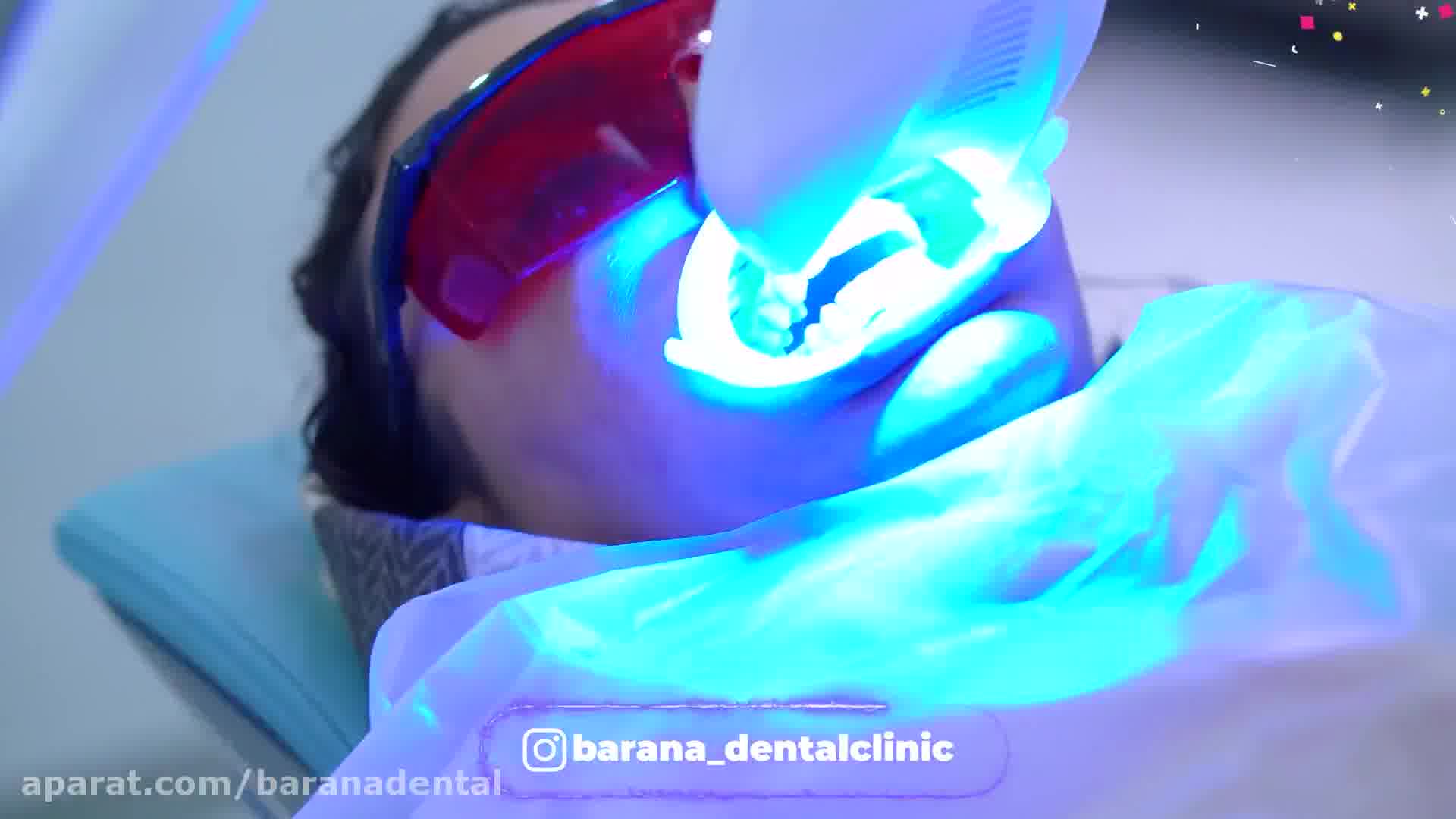 ونیر کامپوزیت با بهترین دندانپزشکان مشهد در کلینیک بارانا