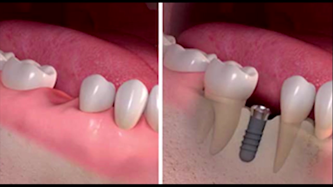 ایمپلنت یک روزه|کلینیک دندانپزشکی مدرن