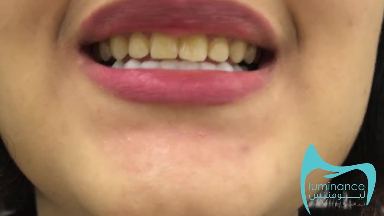 اسنپ آن اسمایل در دندانپزشکی زیبایی|کلینیک دندانپزشکی مدرن