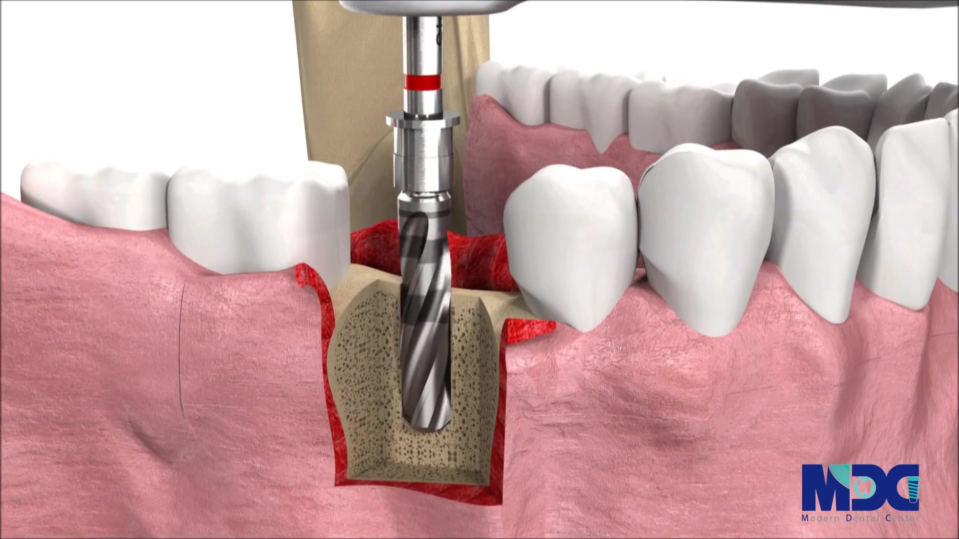 مراحل انجام کاشت دندان|کلینیک دندانپزشکی مدرن