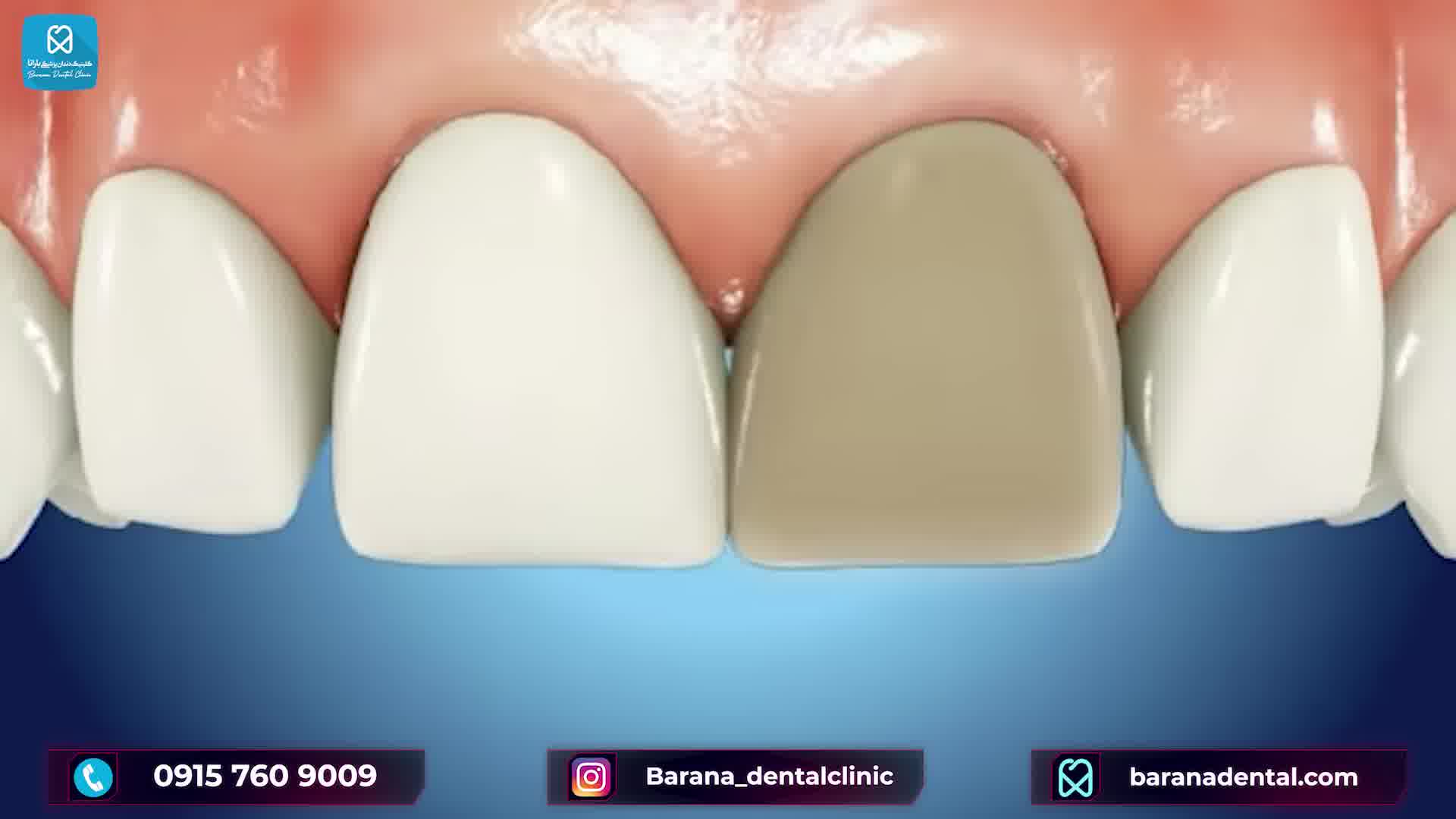 عصب کشی دندان جلو به چه صورت است؟