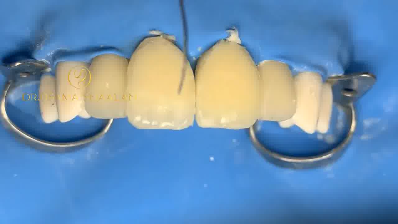 کامپوزیت دندان - مواد دندانپزشکی